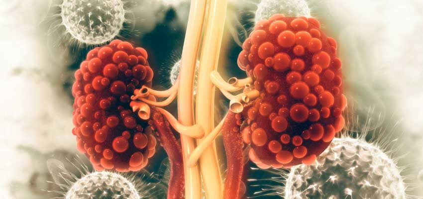 Polycystic Kidney Disease