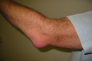 Bursitis Treatment