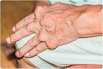 Gout Treatment