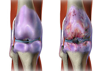 Osteoarthritis – Dhanvantri Ayurveda