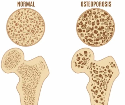 Osteoporosis – Dhanvantri Ayurveda