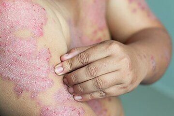 Psoriasis – Dhanvantri Ayurveda